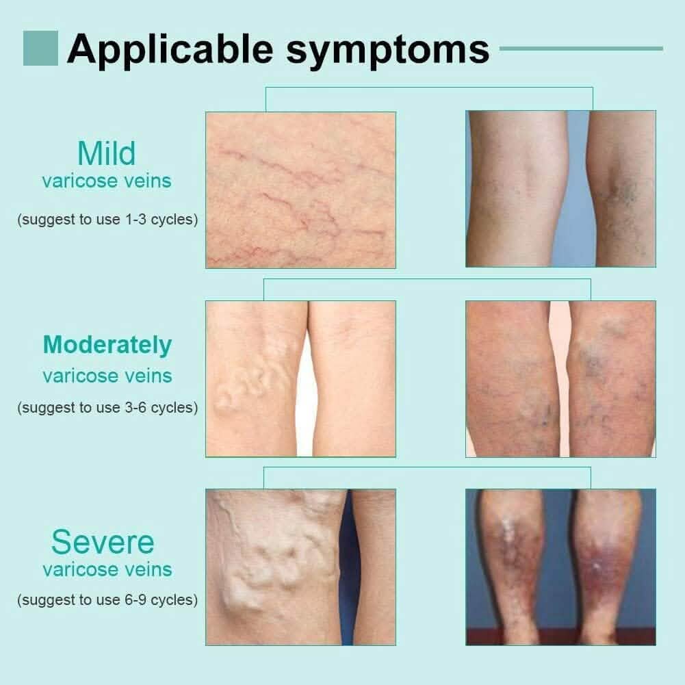 Varicose Deep Nourishing Soothing Vein Cream