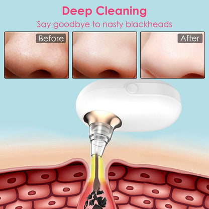 Electric Blackhead Comedone Extractor Tool Facial Pore Cleaner