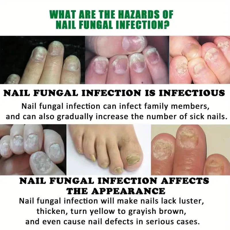 Ginger Nail Care Liquid Onychomycosis Fungus Repair Hand and Foot Nail Care