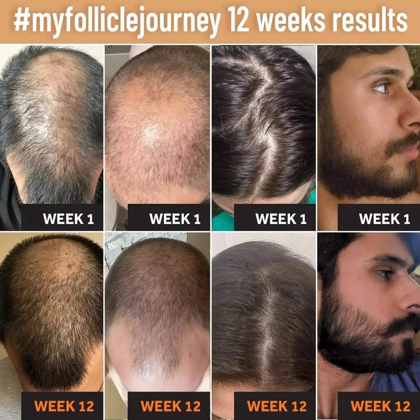 Hair Oil-Biotin Serum Treatment for Stronger Thicker Longer Hair