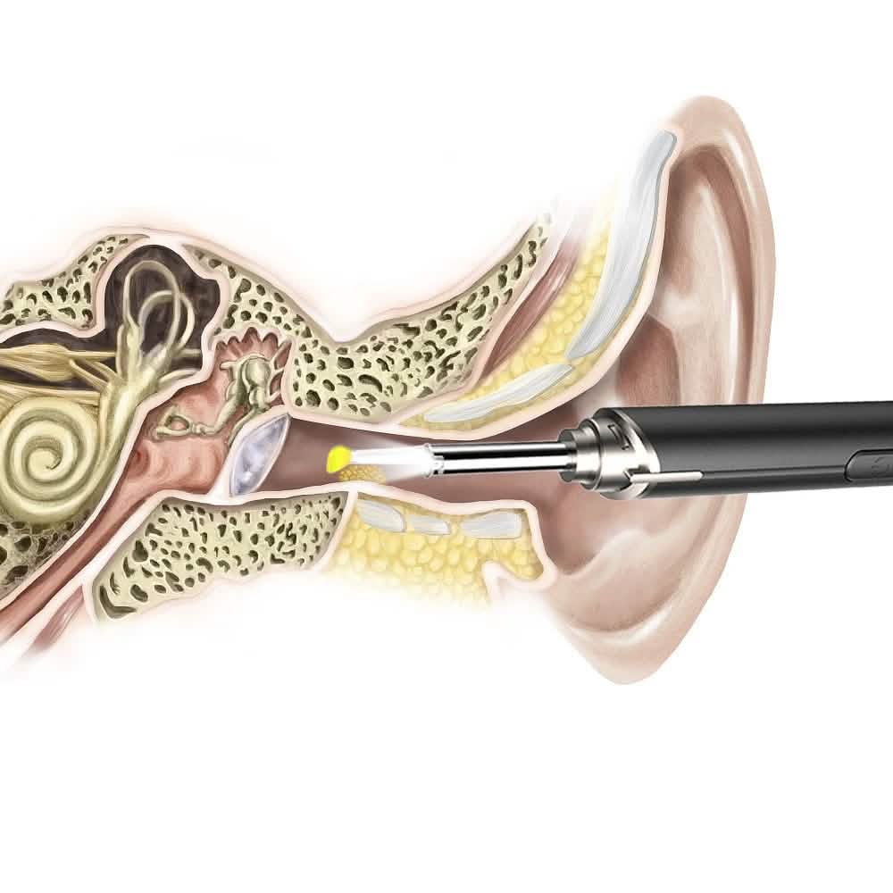 Intelligent Visual Ear Otoscope Inspection Tool