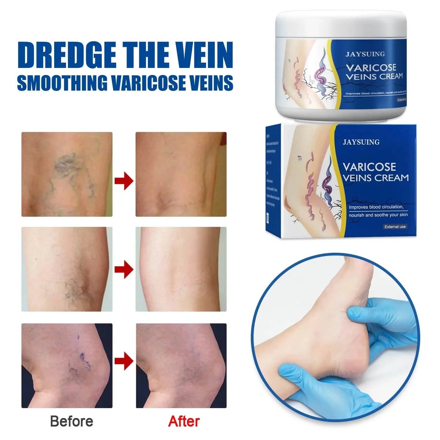 Pain Relief Leg Spider Veins Vasculitis Promote Circulation Smooth Metabolism 30g Exfoliation